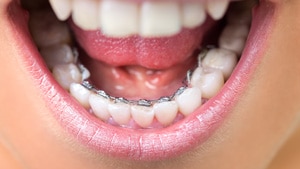 Lingual Braces Top Nova Orthodontics Sterling Potomac Ashburn VA
