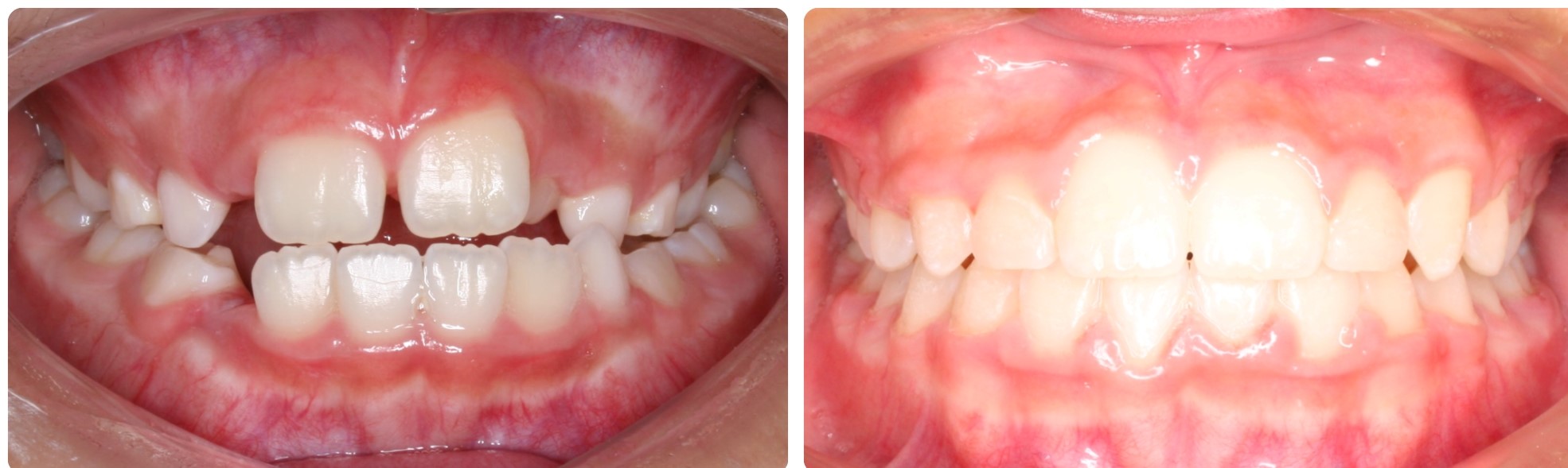 Before-After Cross bite correction