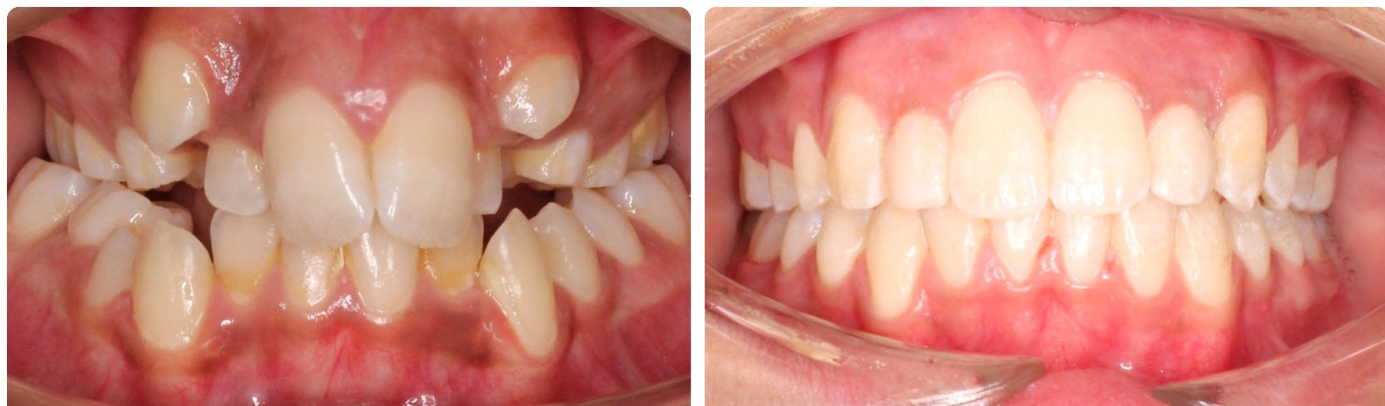 Before-After Braces without extraction