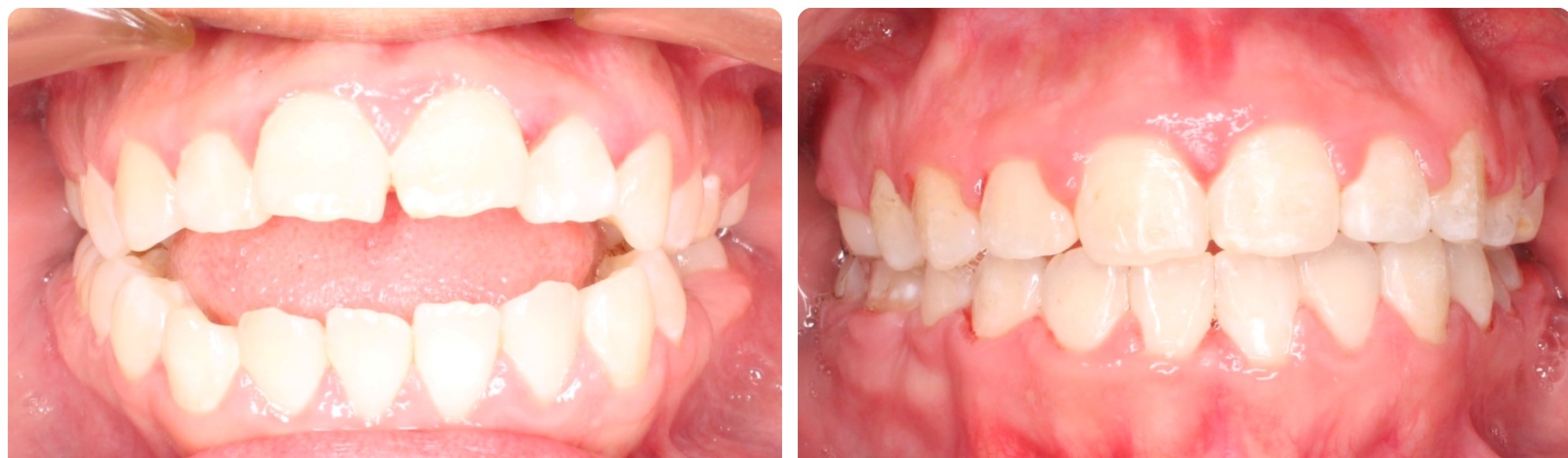 Before-After adult Braces