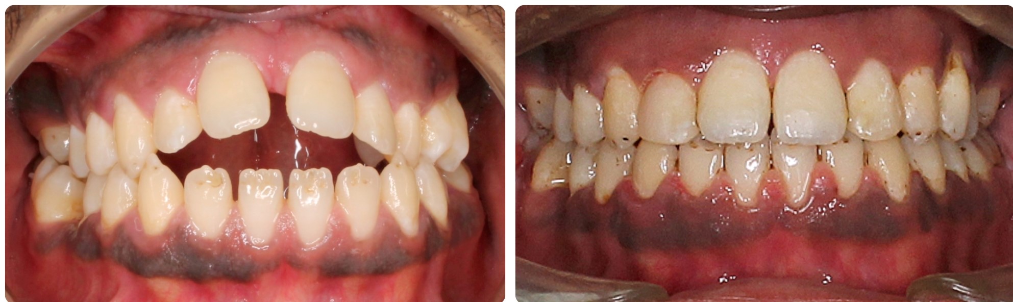 Before-After adult Clear Braces