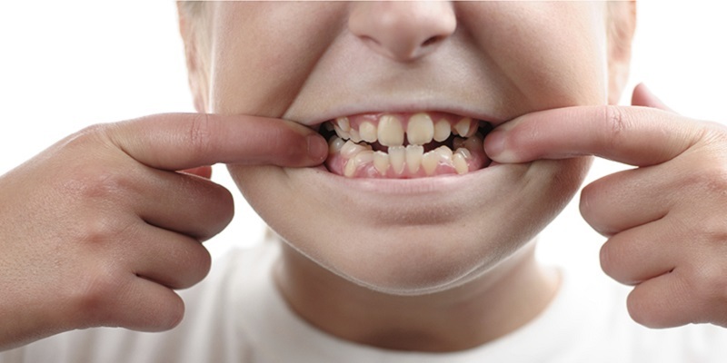 Malocclusion In Children – Causes, Symptoms, And Treatment