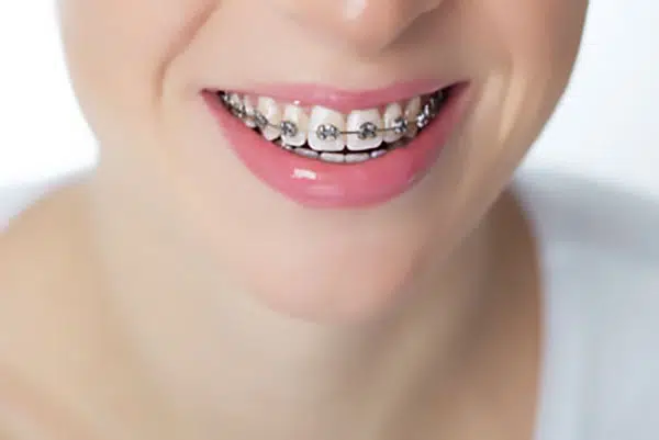 Medicaid Cover Braces