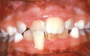 Crossbite of Front Teeth 300x189 1