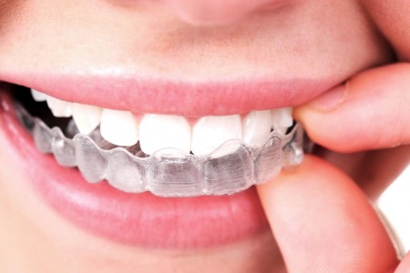 Clear Aligners for Malocclusion