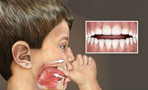 Orthodontic Treatment