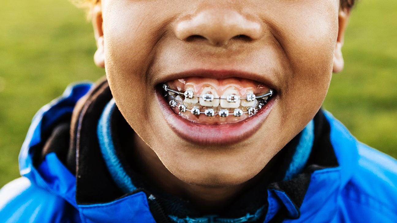 Braces - Traditional Orthodontic Treatment