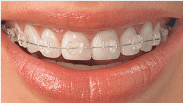 Ceramic Braces