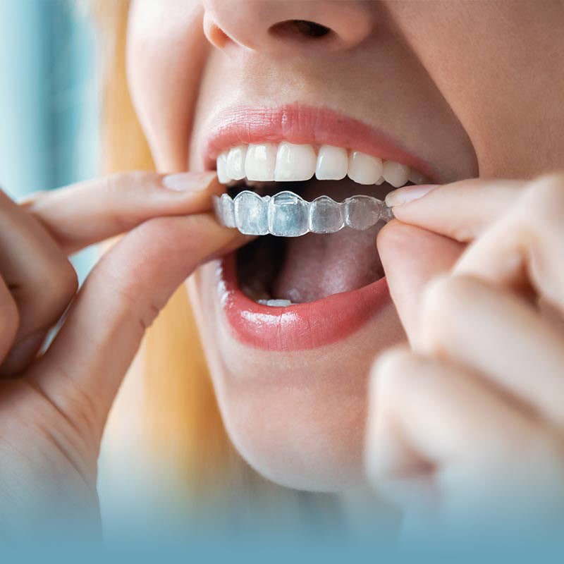 Invisalign - The Clear Aligner Alternative