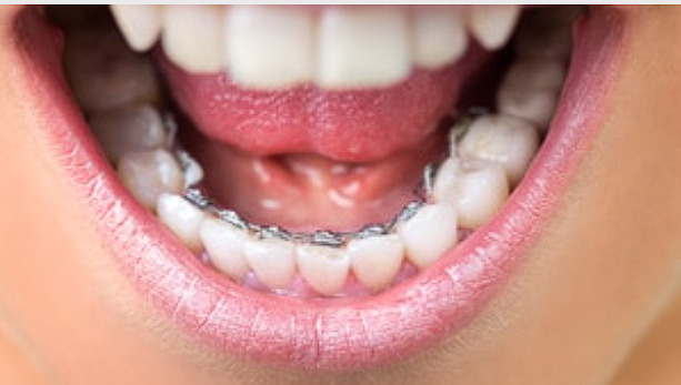 Invisible Braces (Lingual Braces)