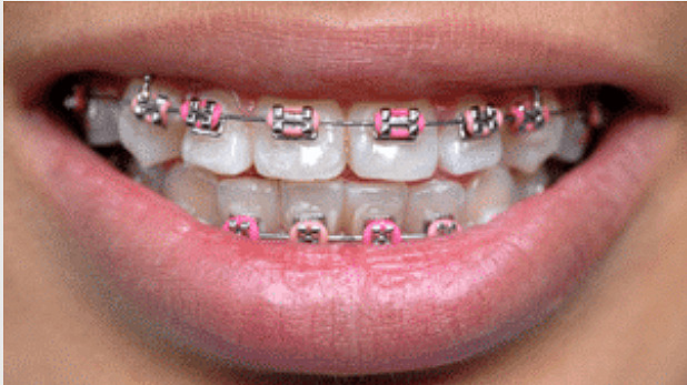 Metal Braces