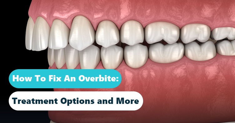 5 Types of Overbites and How to Fix Them: A Comprehensive Guide 2023