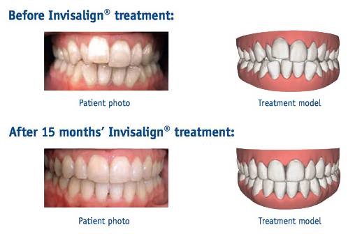 Invisalign before and after