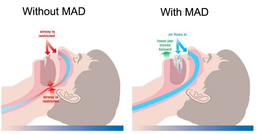 a mandibular advancement device (MAD)