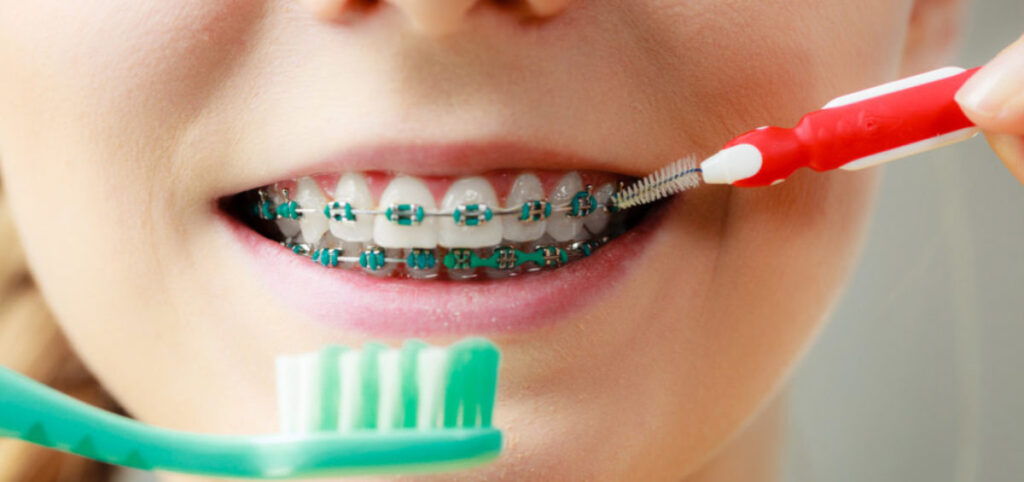 Achieving-Optimal-Oral-Hygiene-with-Braces