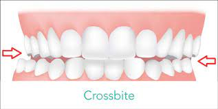 Cross-Bite-Symptoms