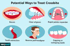 Cross-Bite-Treatment-Options