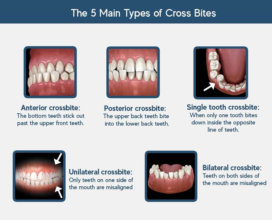 Cross-Bite-Types