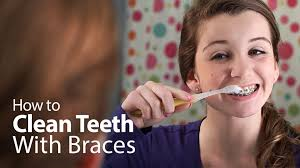 How to clean teeth with Braces
