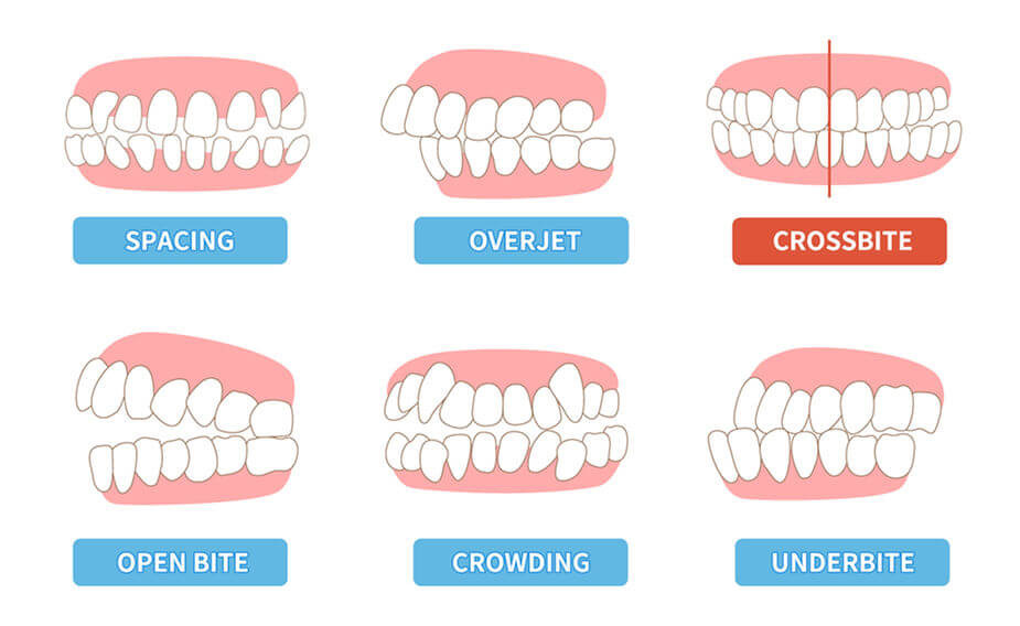 Mastering-Cross-Bite-Solutions-for-2023- Unlock-Your-Best-smile