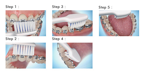 Techniques for brushing