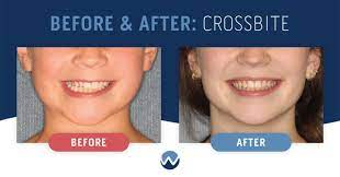 before-and-after-Cross-bite
