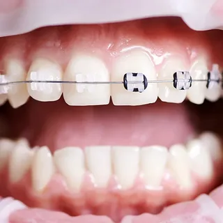 Clear braces from Top Nova Orthodontics