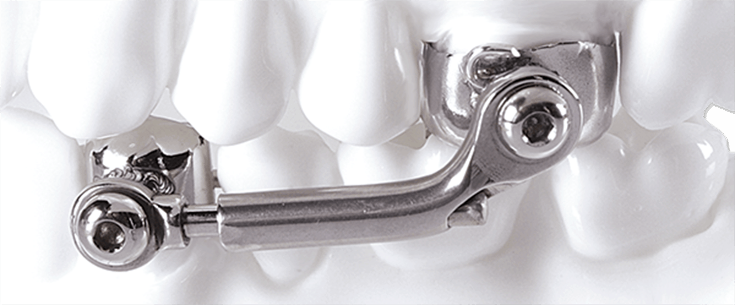 Best Herbst Class II Corrector Treatments In Sterling, VA