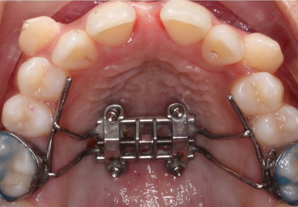 MSE or MARPE is a Maxillary skeletal expander used in orthodontics to widen the upper jaw in patients older than 12 years old.
