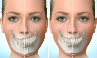 Side-by-side images of a woman’s face with skeletal overlays showing jaw structure, demonstrating skeletal facial asymmetry and its impact on overall facial balance.